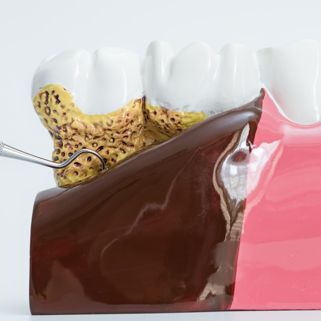 Mitos y verdades sobre la enfermedad periodontal: lo que realmente debes saber